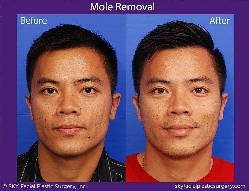 Mole Removal Before & After