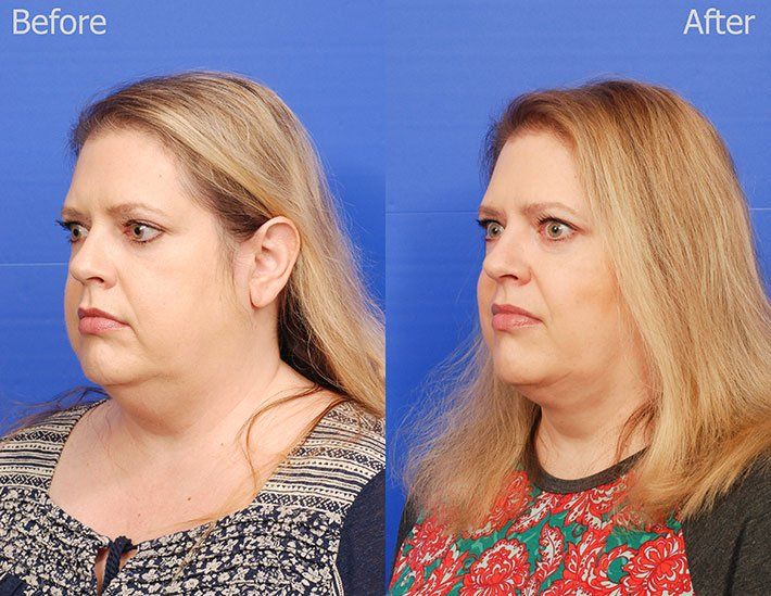 Kybella Before & After