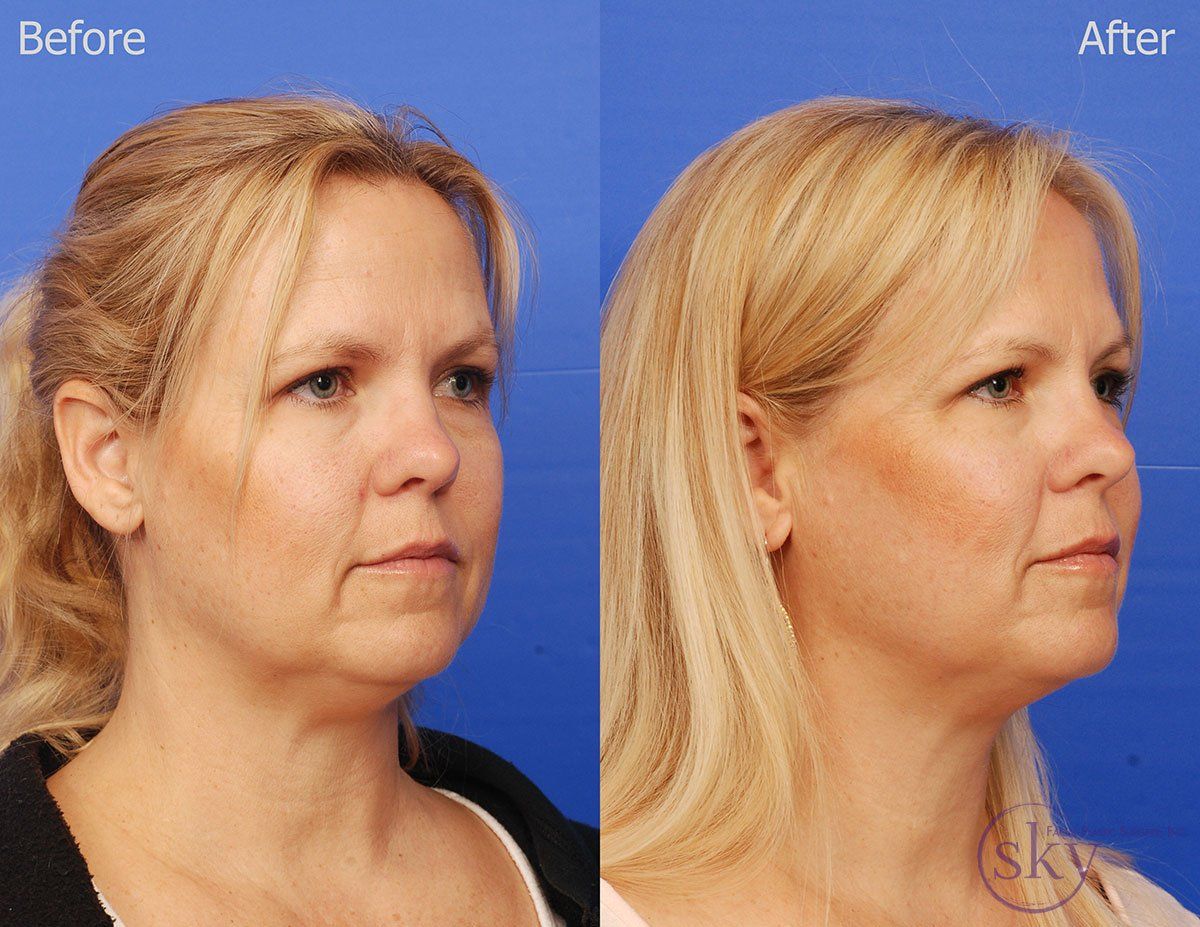 Kybella Before & After