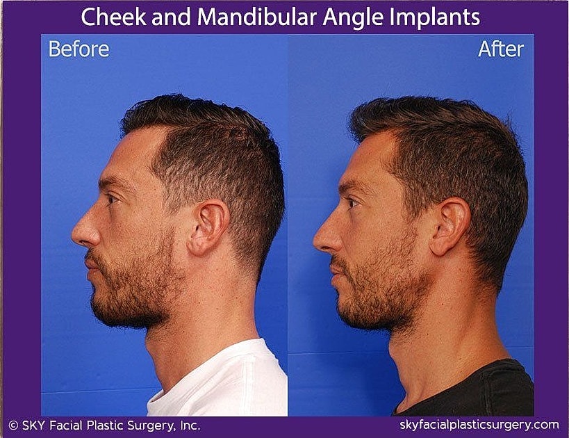 Jaw Contouring Before & After