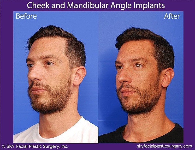 Jaw Contouring Before & After