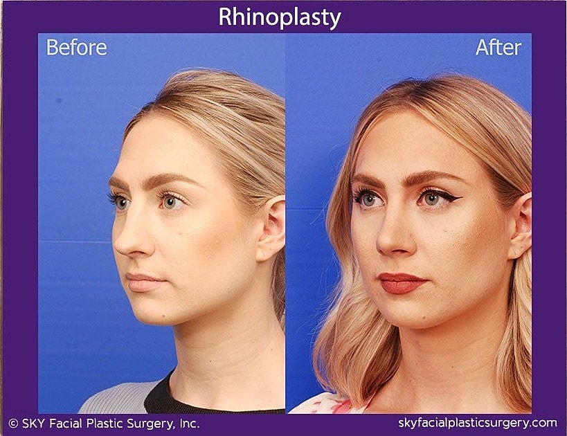 Rhinoplasty Before & After