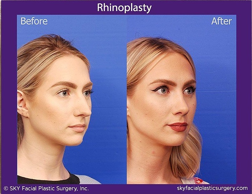 Rhinoplasty Before & After