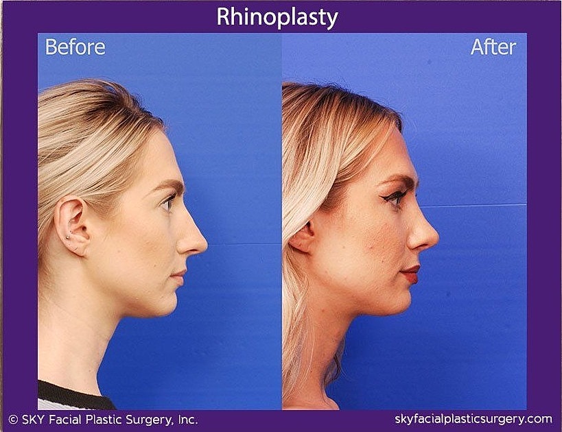Rhinoplasty Before & After