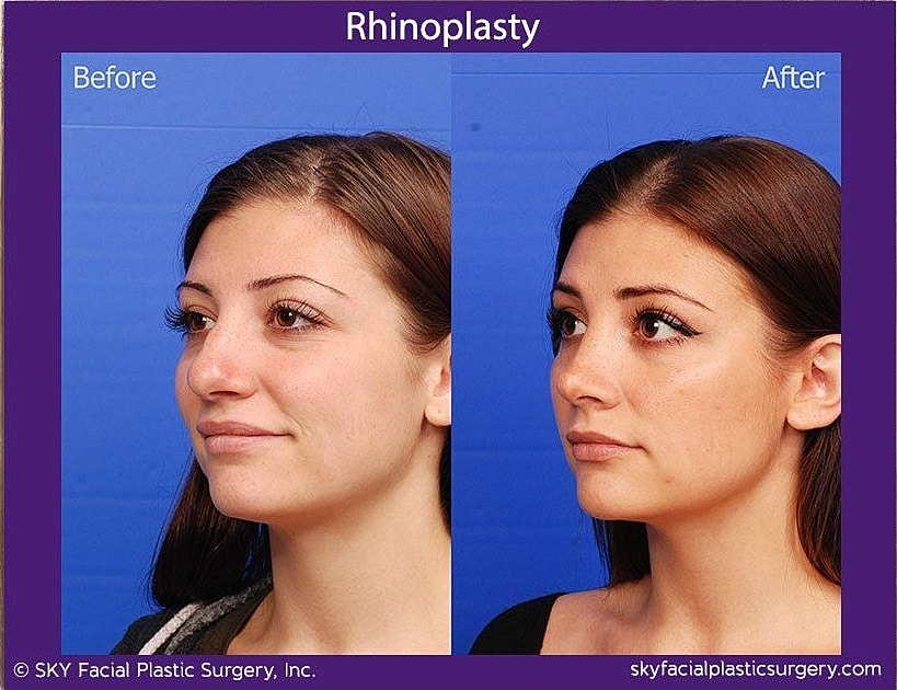 Rhinoplasty Before & After