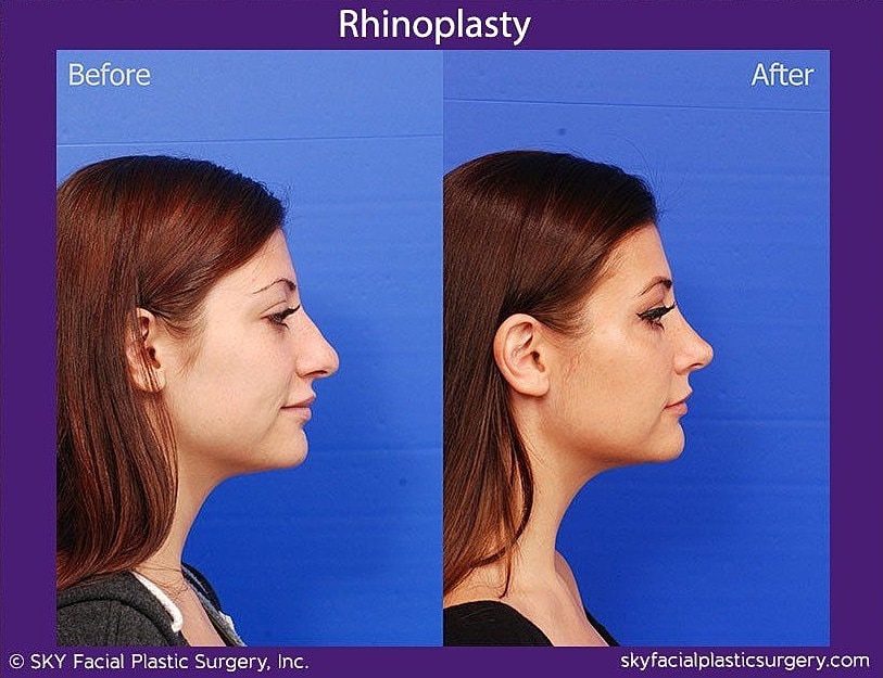 Rhinoplasty Before & After