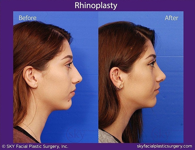 Rhinoplasty Before & After