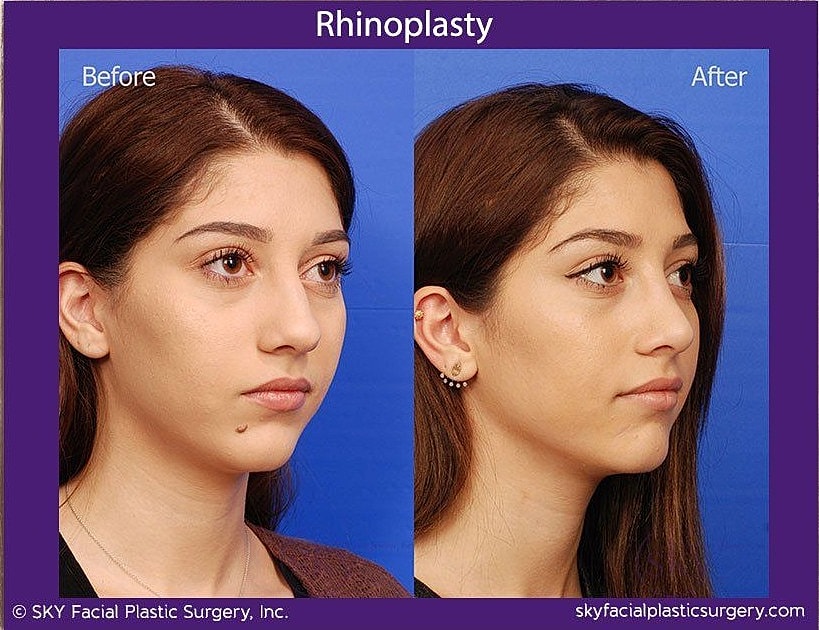 Rhinoplasty Before & After