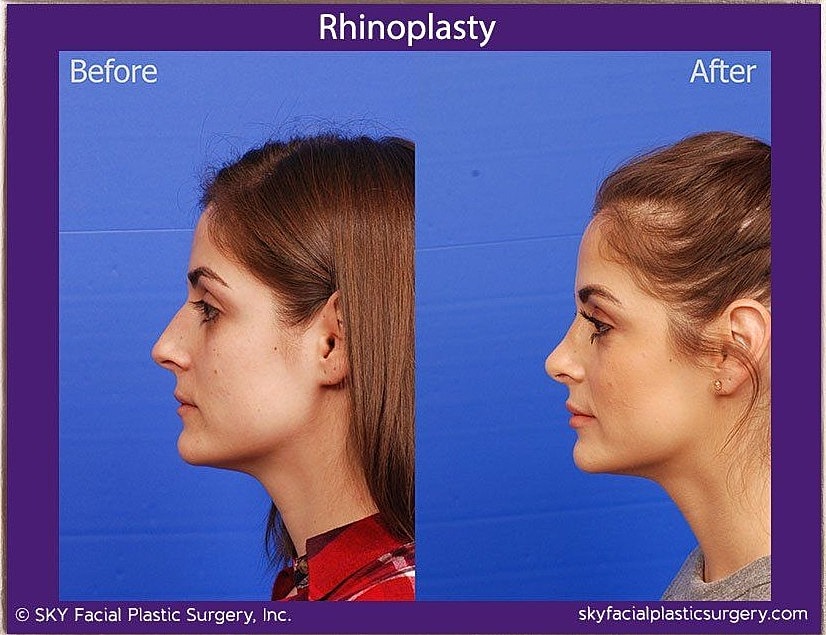Rhinoplasty Before & After