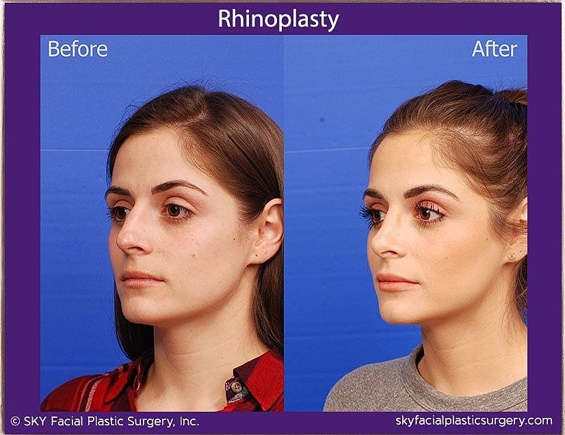 Rhinoplasty Before & After