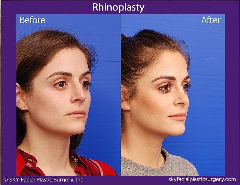 Rhinoplasty Before & After