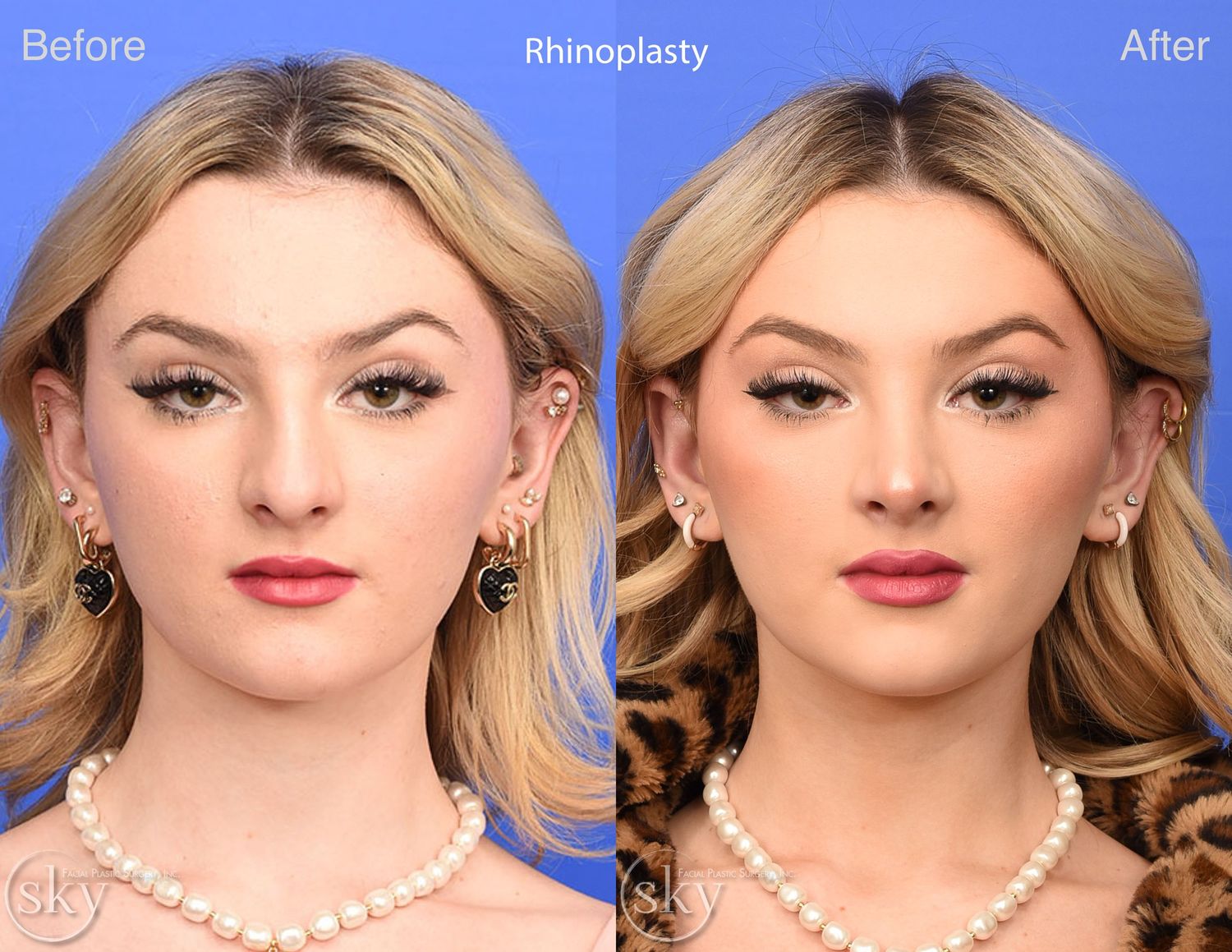 Rhinoplasty Before & After