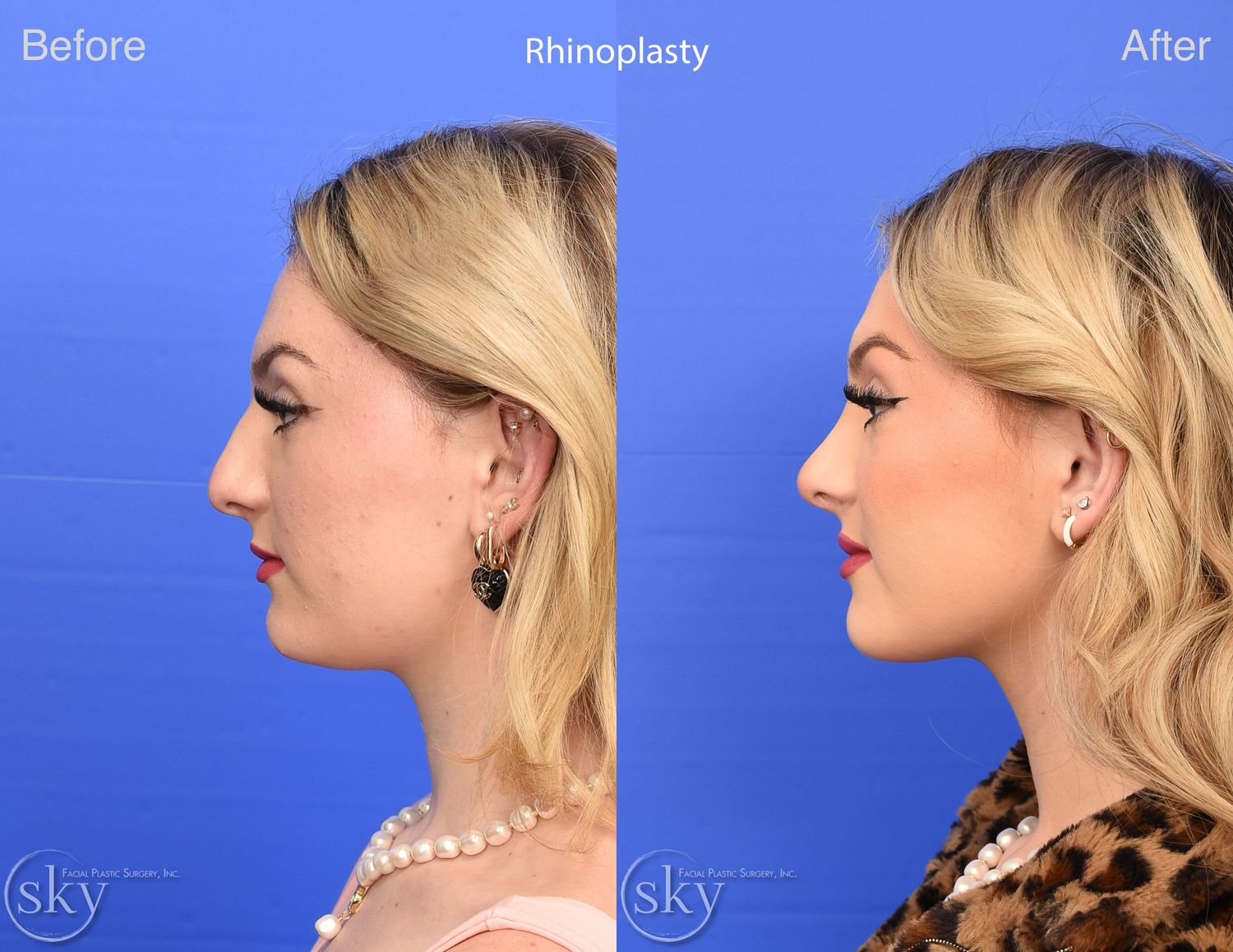 Rhinoplasty Before & After