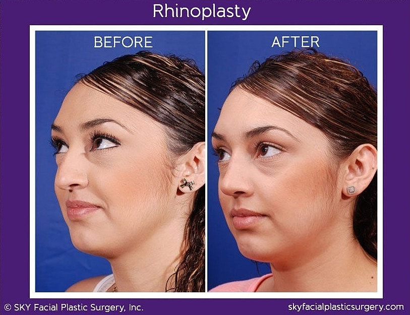 Rhinoplasty Before & After