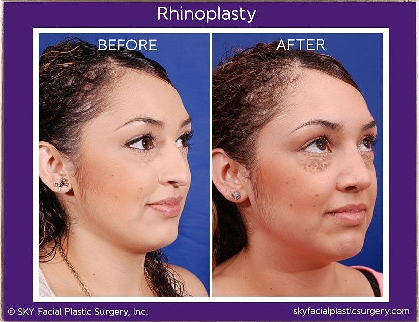 Rhinoplasty Before & After