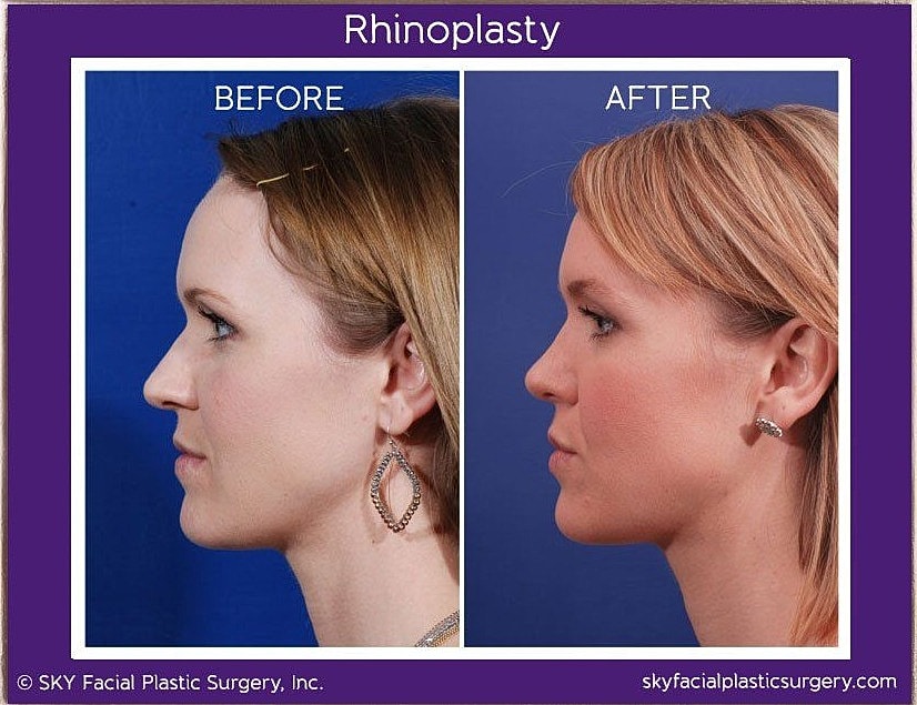 Rhinoplasty Before & After