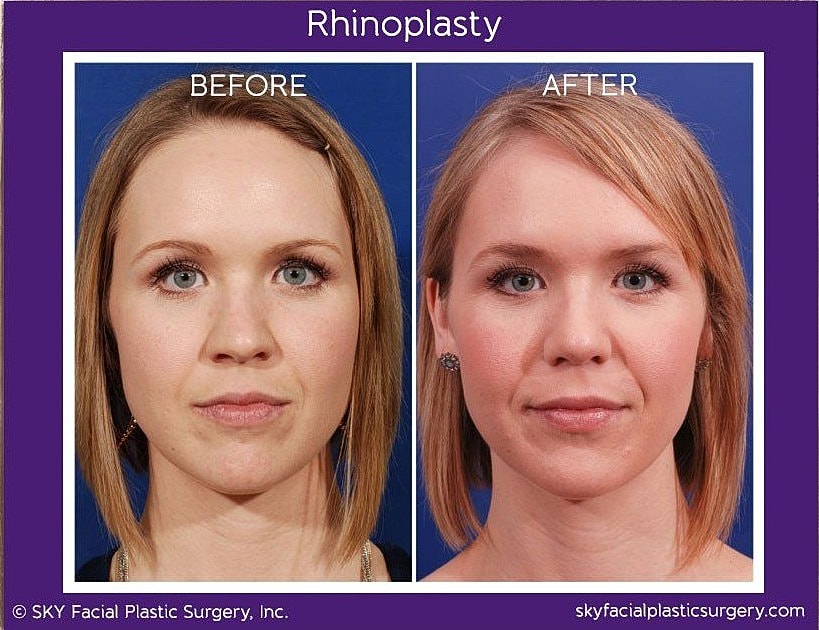 Rhinoplasty Before & After