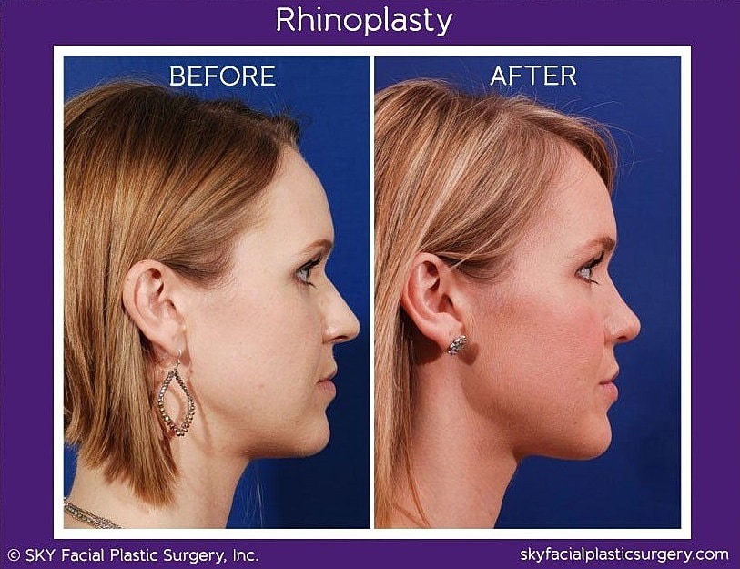 Rhinoplasty Before & After