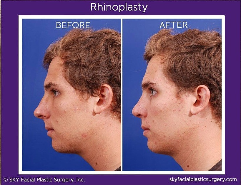 Rhinoplasty Before & After