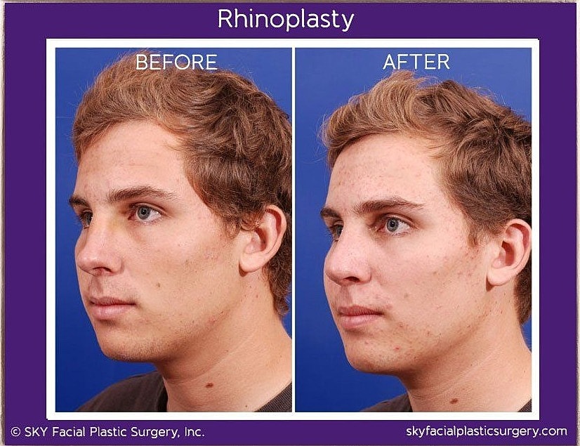 Rhinoplasty Before & After