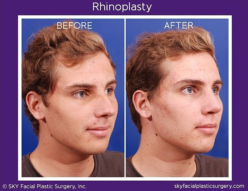 Rhinoplasty Before & After