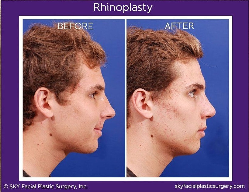 Rhinoplasty Before & After