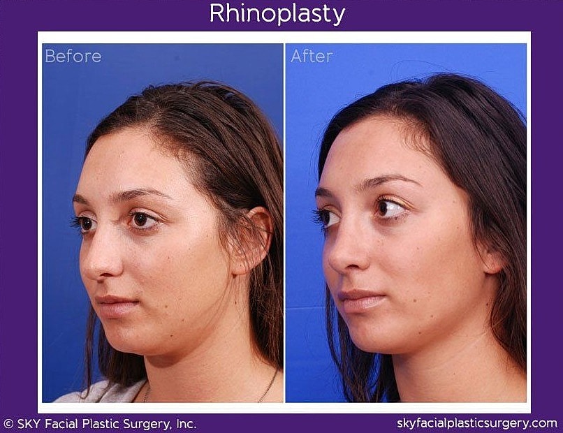 Rhinoplasty Before & After