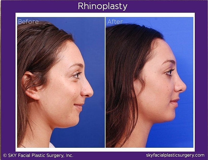 Rhinoplasty Before & After