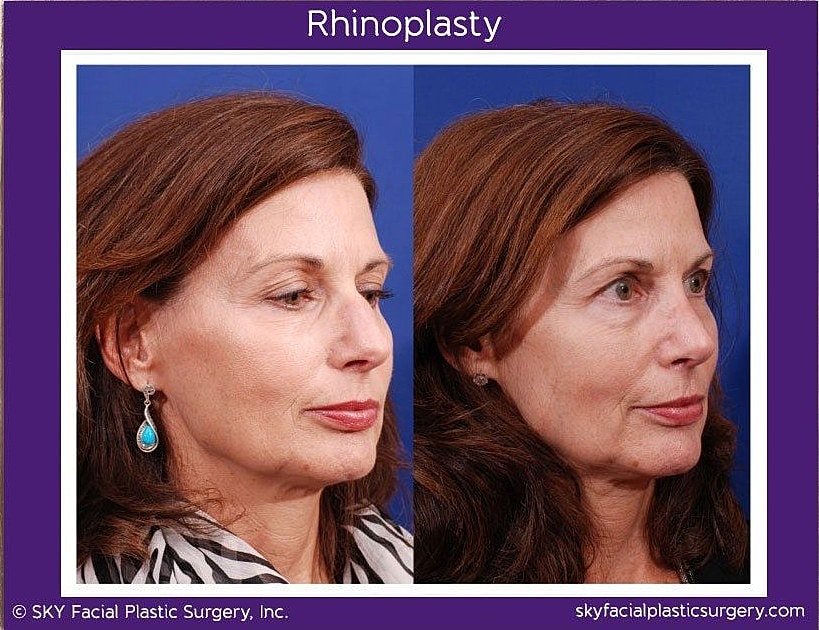Rhinoplasty Before & After