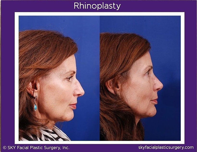 Rhinoplasty Before & After