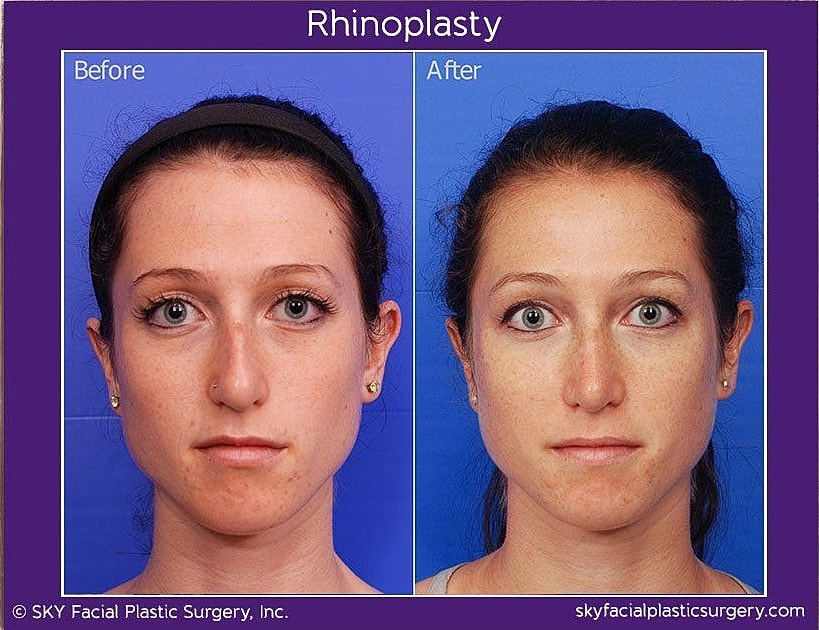 Rhinoplasty Before & After