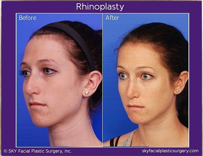 Rhinoplasty Before & After