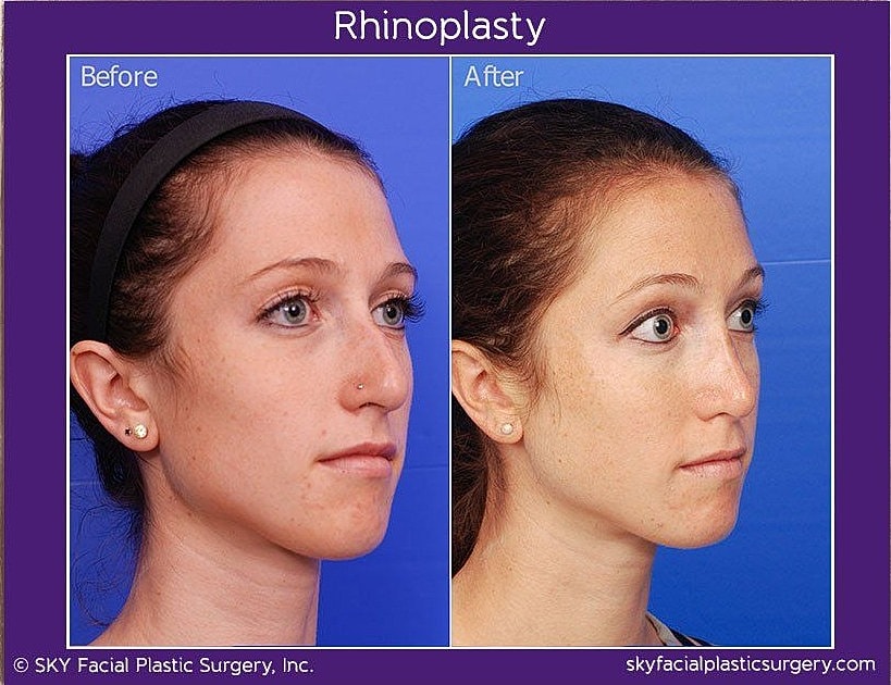 Rhinoplasty Before & After