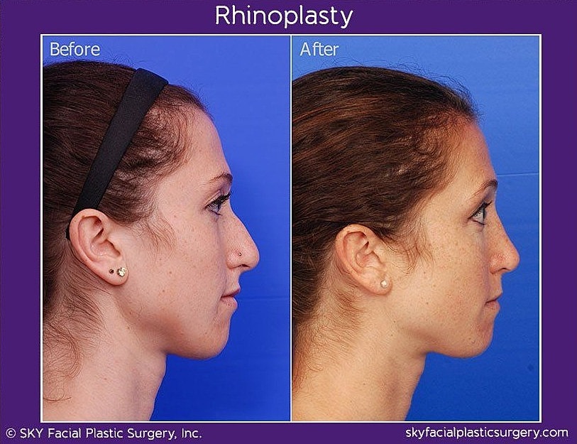 Rhinoplasty Before & After
