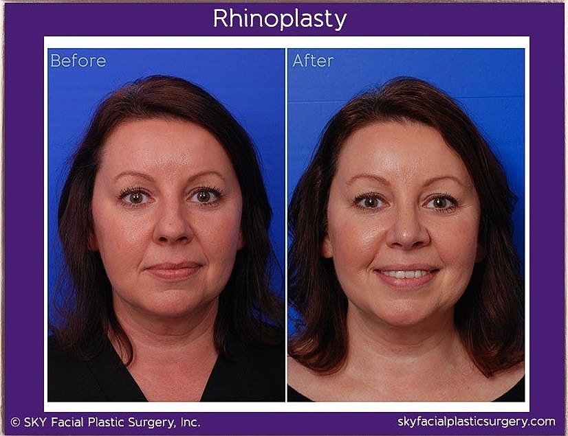 Rhinoplasty Before & After
