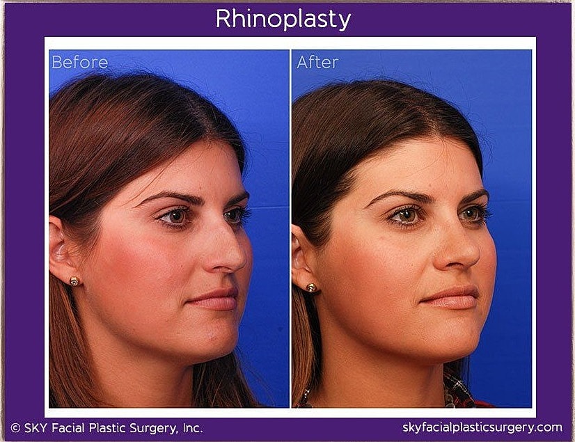 Rhinoplasty Before & After