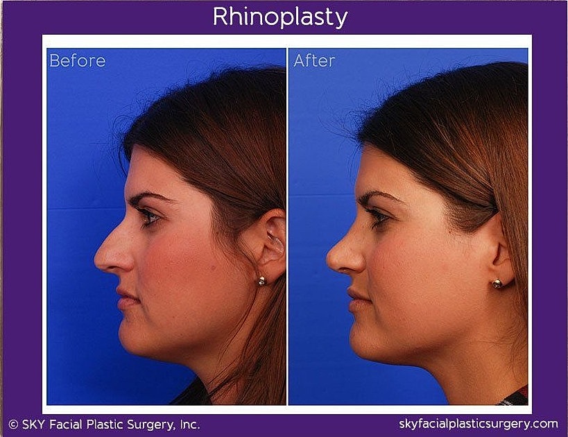 Rhinoplasty Before & After