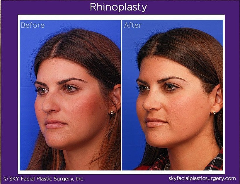 Rhinoplasty Before & After