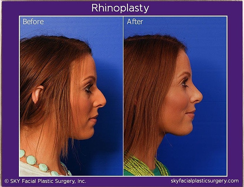 Rhinoplasty Before & After