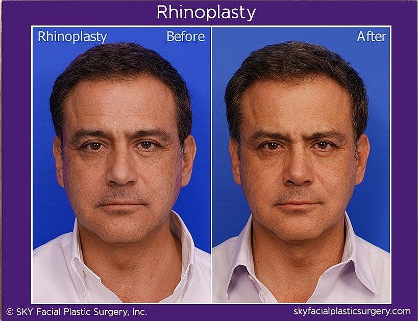 Rhinoplasty Before & After