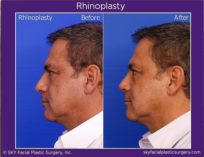 Rhinoplasty Before & After