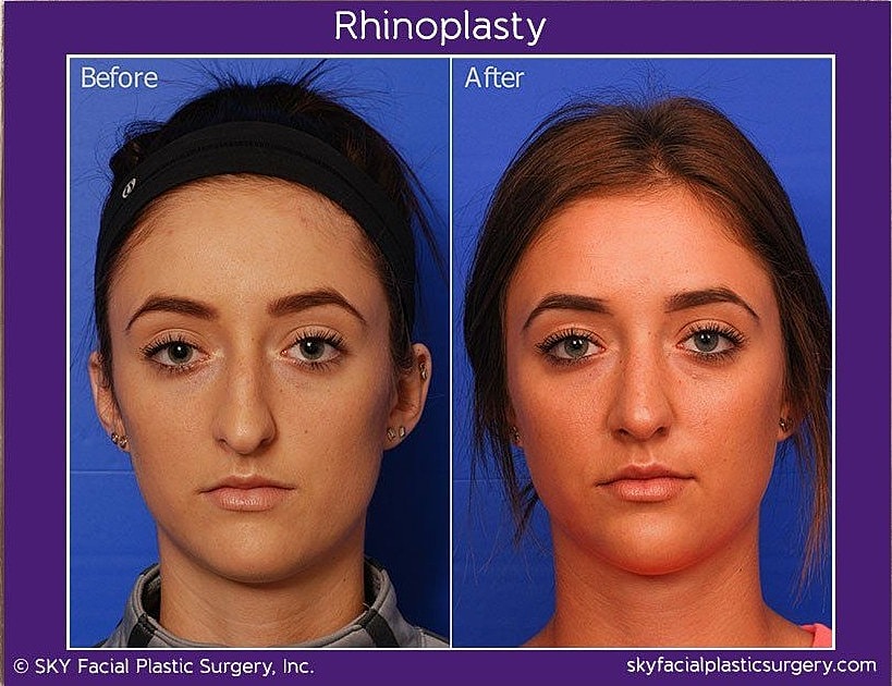 Rhinoplasty Before & After