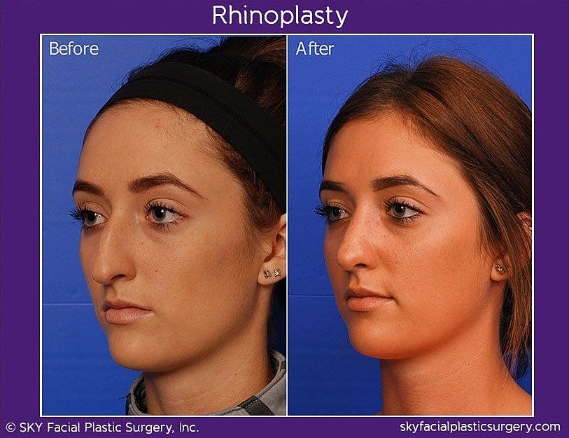 Rhinoplasty Before & After
