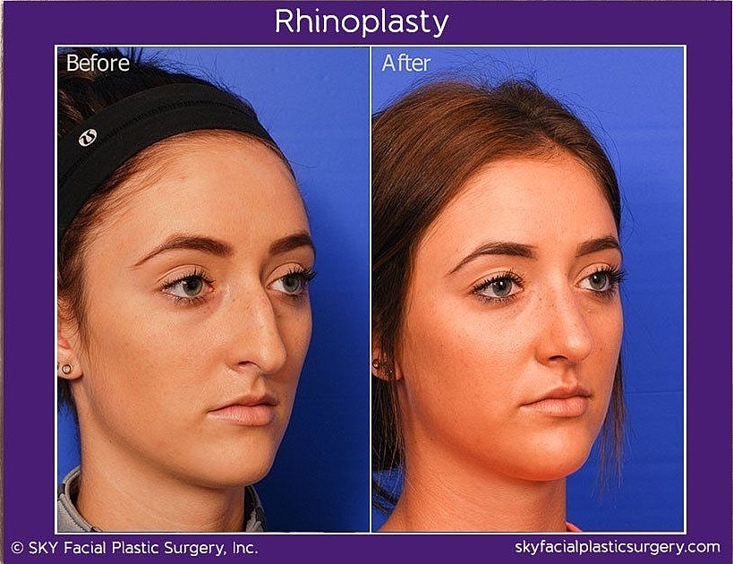Rhinoplasty Before & After