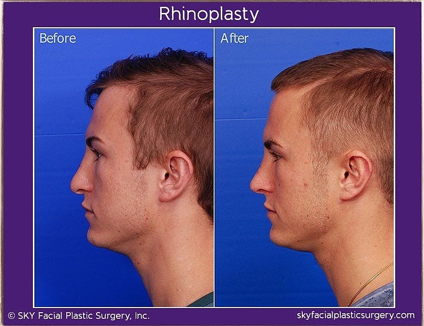 Rhinoplasty Before & After