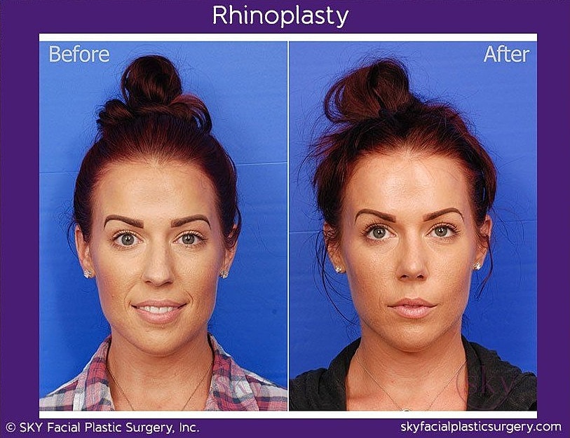 Rhinoplasty Before & After