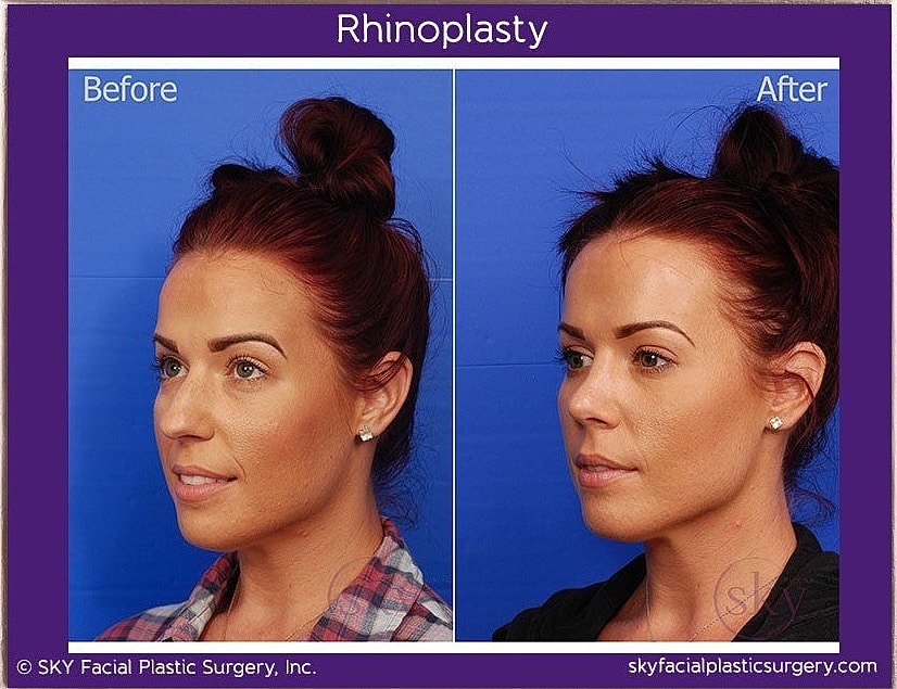 Rhinoplasty Before & After
