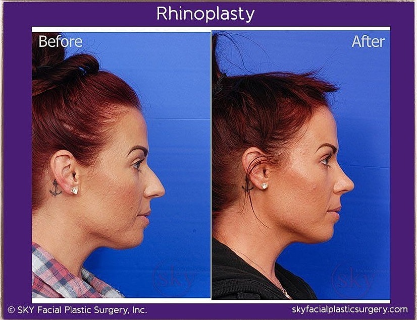Rhinoplasty Before & After