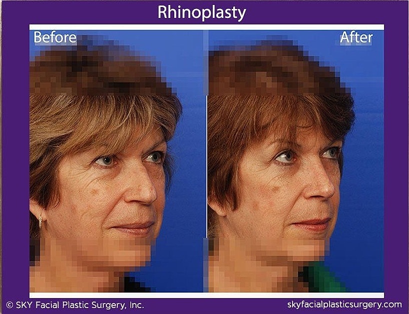 Rhinoplasty Before & After
