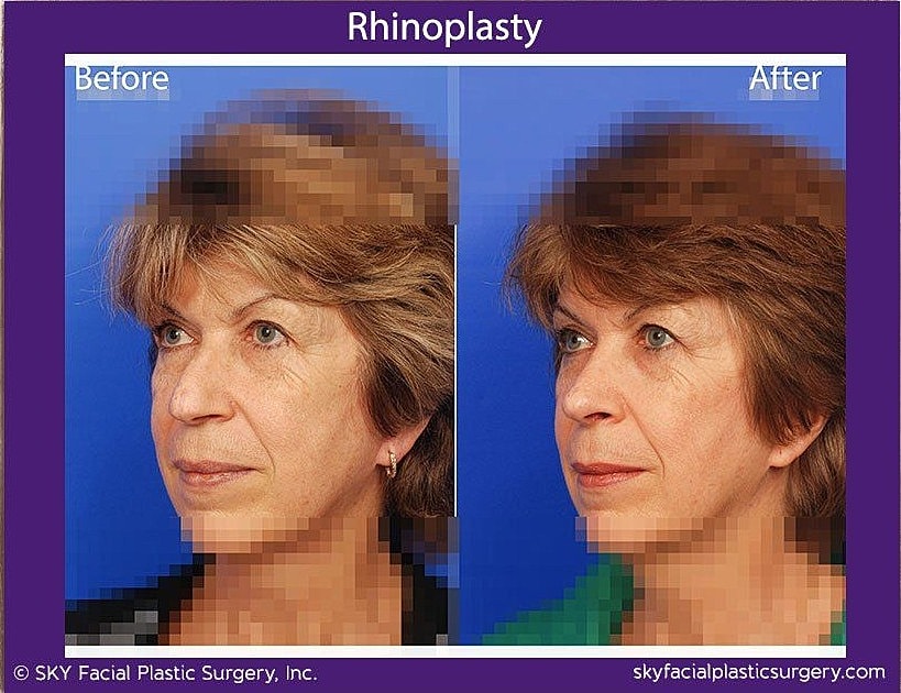 Rhinoplasty Before & After